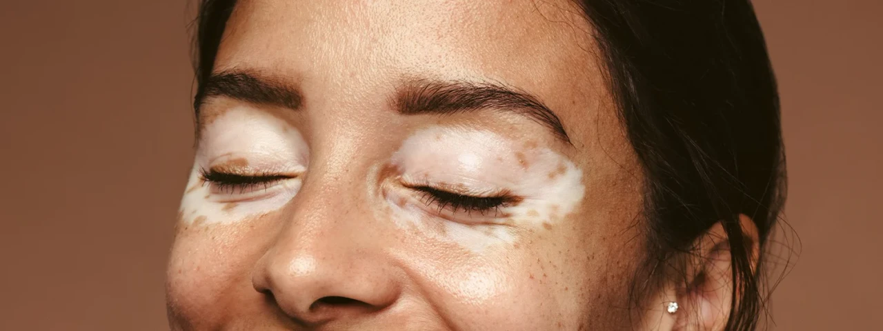 Mulher feliz com melasma na região dos olhos